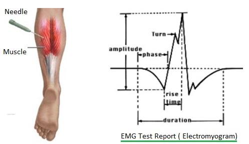 EMG electromyogram